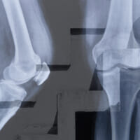 変形性膝関節症の重症度（ステージ分類）はどう決まるか | 整形外科専門医コラム