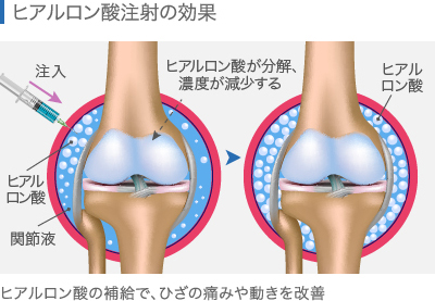 ヒアルロン酸注射の効果