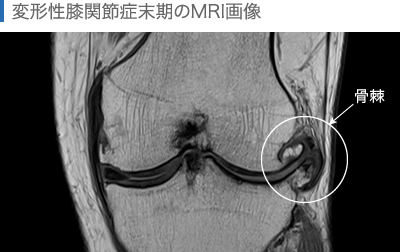 変形性膝関節症末期のMRI画像