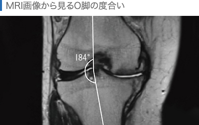MRI画像から見るO脚の度合い