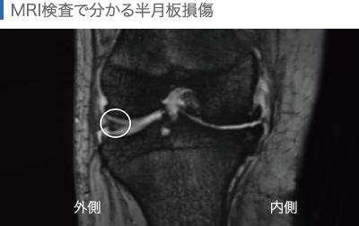 MRI検査でわかる半月板損傷