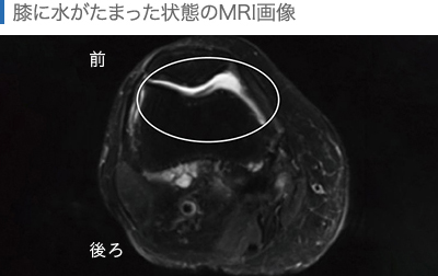 膝に水が溜まった状態のMRI画像