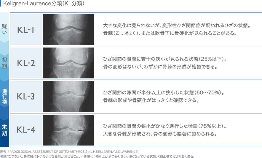 Kellgren-Laurence分類(KL分類)