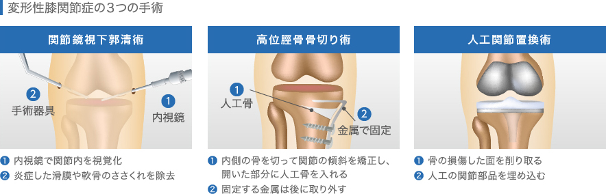 変形性膝関節症の3つの手術
