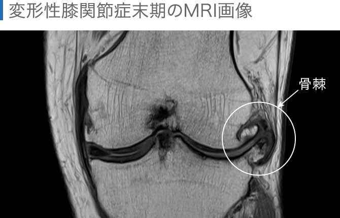 関節のMRI
