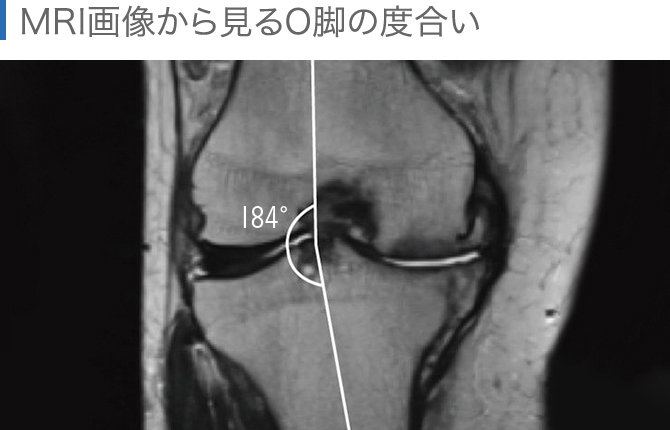膝のmri検査で何がわかる 知っておきたいmriとレントゲンの違い