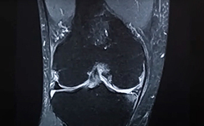 右ひざのMRI画像