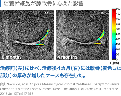 培養幹細胞がひざ軟骨に与えた影響