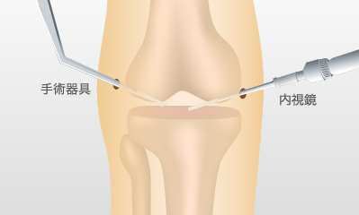 関節鏡視下手術