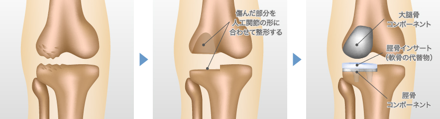 人工膝関節単顆置換術（UKA）