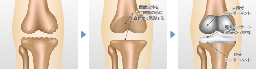 人工膝関節全置換術（TKA）