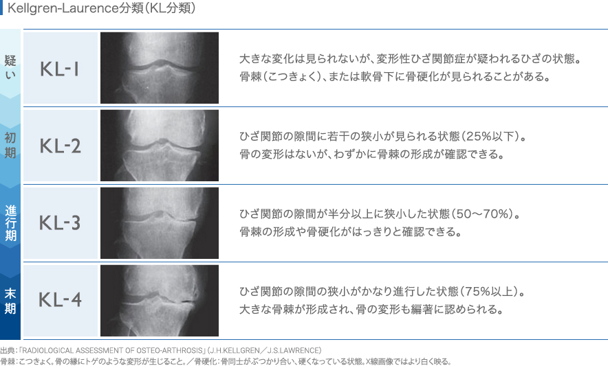 Kellgren-Laurence分類(KL分類)
