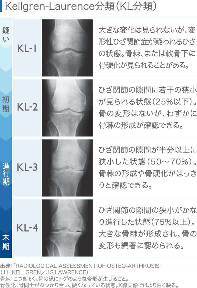 変形性膝関節症の手術【費用／タイミング／術後の入院期間】│ひざ関節