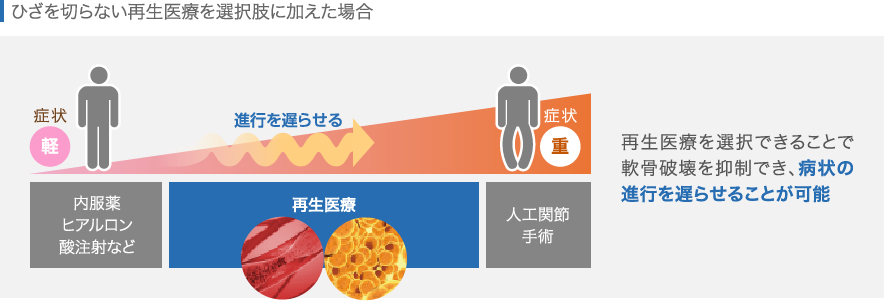 変形性膝関節症の進行と再生医療