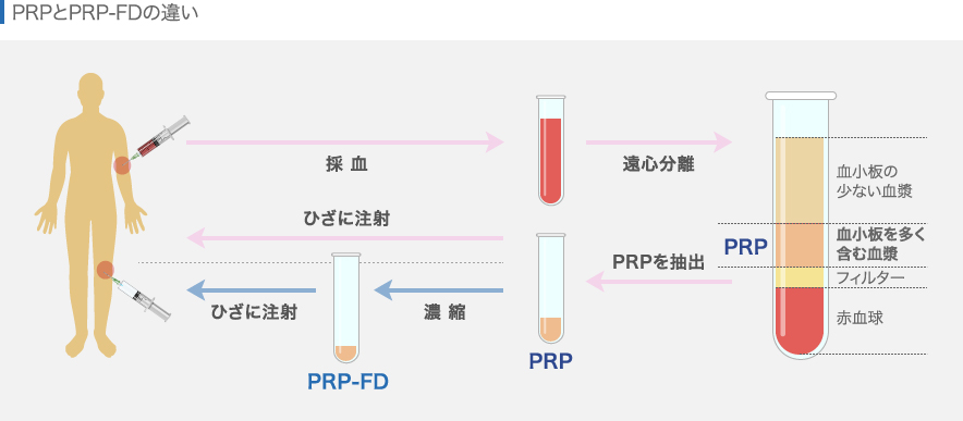 PRPとPRP-FDの違い