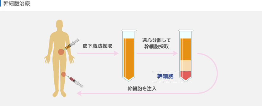 幹細胞(ASC)治療