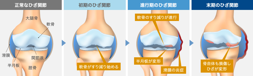 変形性膝関節症の進行