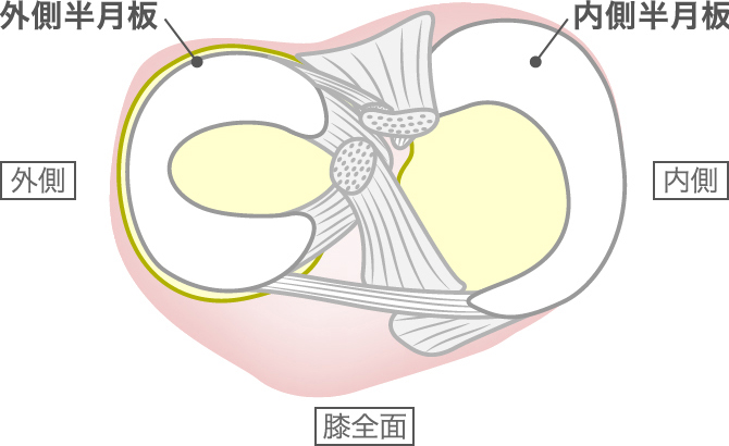 半月板損傷のリハビリ 早く治すために行うべき13の方法 ひざ関節症クリニック