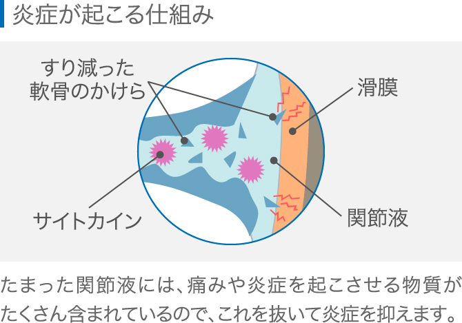 膝に水が溜まったらすぐ対処しましょう 専門医が理由を解説 ひざ関節症クリニック