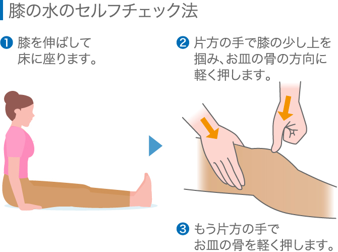 膝に水が溜まる原因は 抜いた方がいい 専門医が対処法を解説 ひざ関節症クリニック