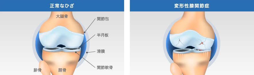 正常な膝と変形性膝関節症の膝