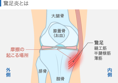 鵞足炎とは