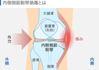 内側側副靭帯損傷とは