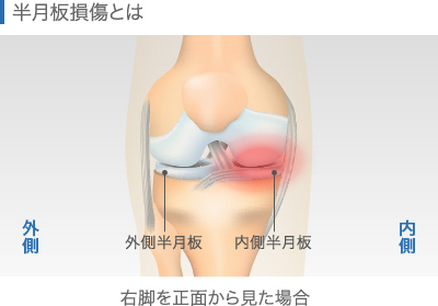 半月板損傷