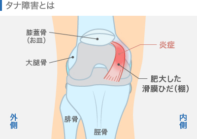 ひざのタナ障害