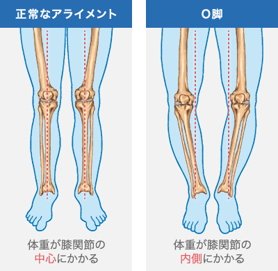 O脚（太ももや膝が左右でくっつかない状態）