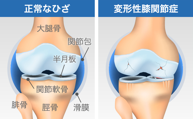 ひざの内側が痛いのはなぜ 原因となる病気や対処方法