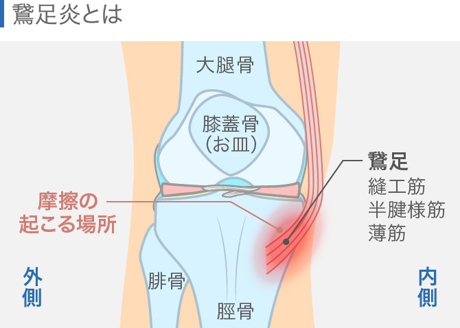 ひざの内側が痛いのはなぜ 原因となる病気や対処方法
