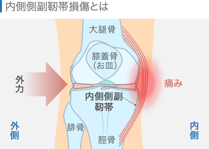 ひざの内側が痛いのはなぜ 原因となる病気や対処方法