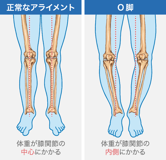 ひざの内側が痛いのはなぜ 原因となる病気や対処方法