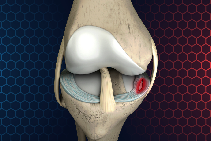 半月板損傷は自然治癒しない 有効な治療法を専門医が解説 ひざ関節症クリニック