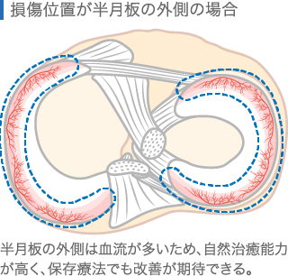 損傷位置が半月板の外側の場合