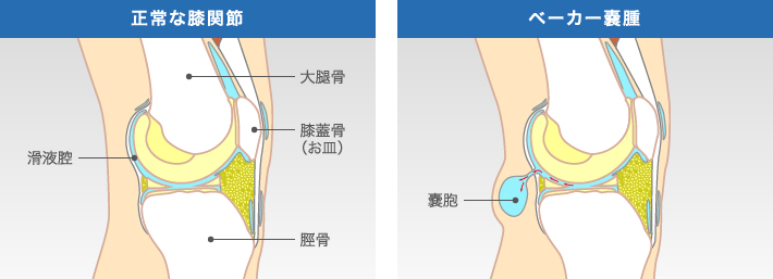 正常な膝関節とベーカー嚢腫になった膝