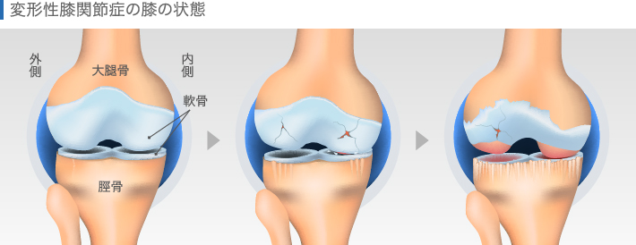 変形性膝関節症の膝の状態