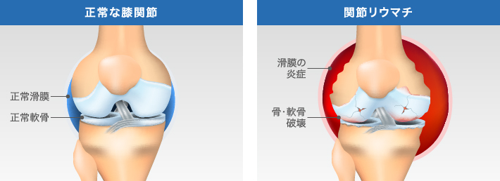 正常な膝関節と関節リウマチになった膝