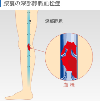 膝裏の深部静脈血栓症