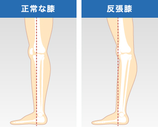 正常な膝関節と反張膝