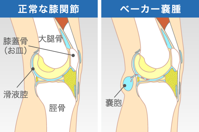 ひざの裏が痛くなるのはなぜ 医師が教える原因と対処法 ひざ関節症クリニック