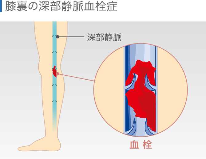 ひざの裏が痛くなるのはなぜ 医師が教える原因と対処法 ひざ関節症クリニック