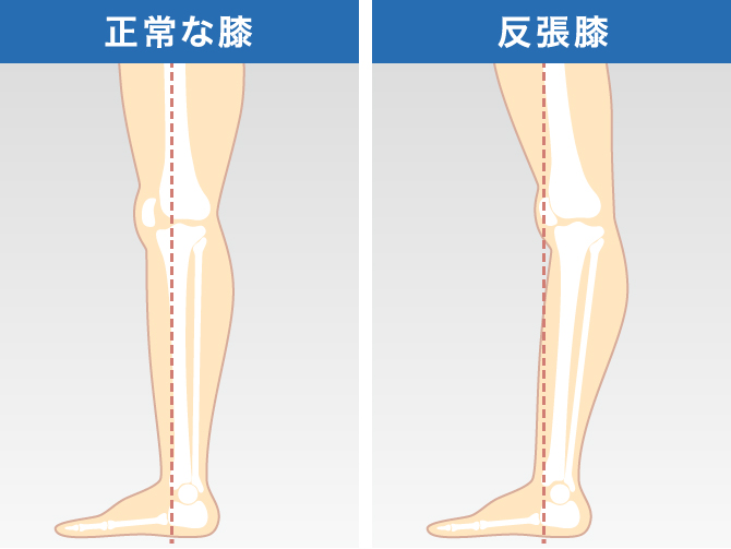 膝の裏が痛い原因や考えられる病気は ベーカー嚢腫や変形性膝関節症を解説 ひざ関節症クリニック