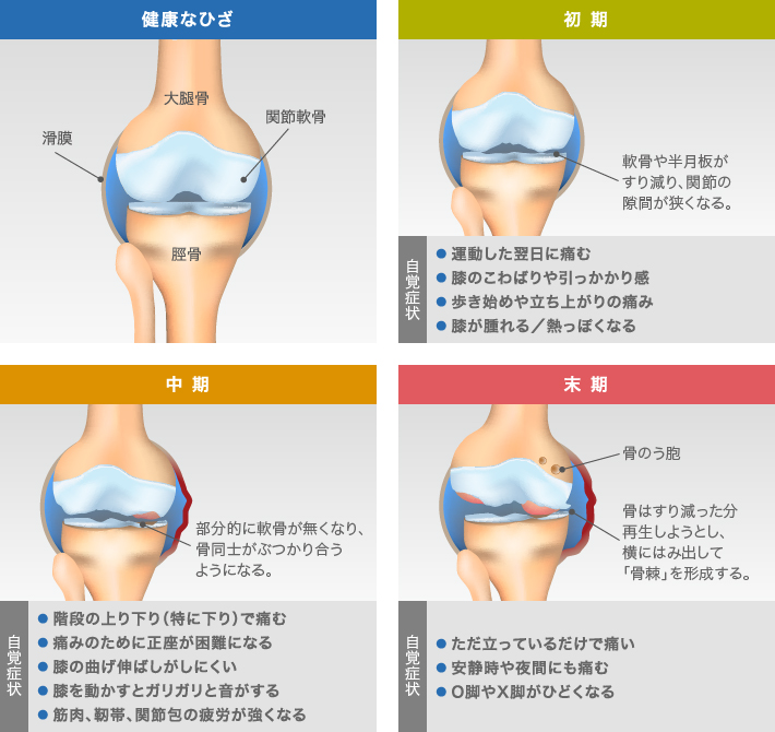 膝軟骨がすり減る過程と自覚症状