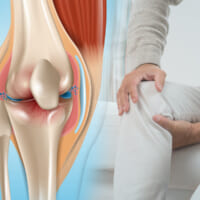 膝軟骨の「すり減り」は変形性膝関節症【原因と治療法について】