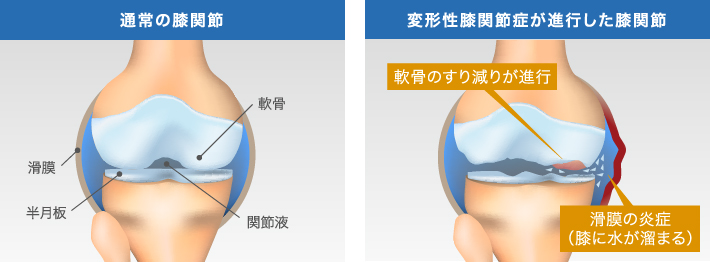 通常の膝関節と変形性膝関節症が進行した膝関節