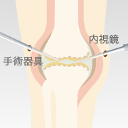 図解 関節鏡視下手術