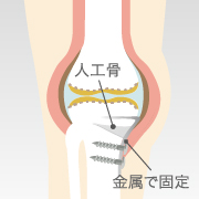 図解 高位脛骨骨切り術