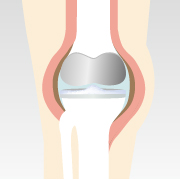 図解 人工膝関節置換術